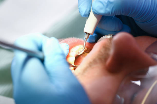 Best Emergency Tooth Extraction in Portland, IN
